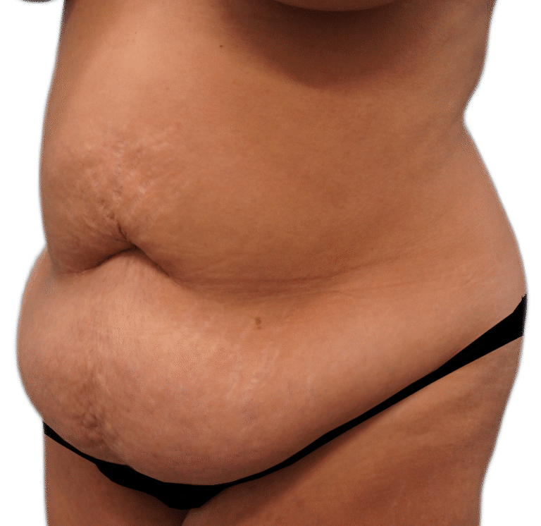 Before Image: Tummy Tuck - left-front-oblique