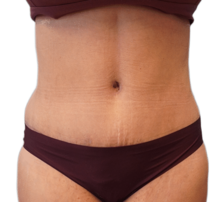 After Image: Tummy Tuck - front