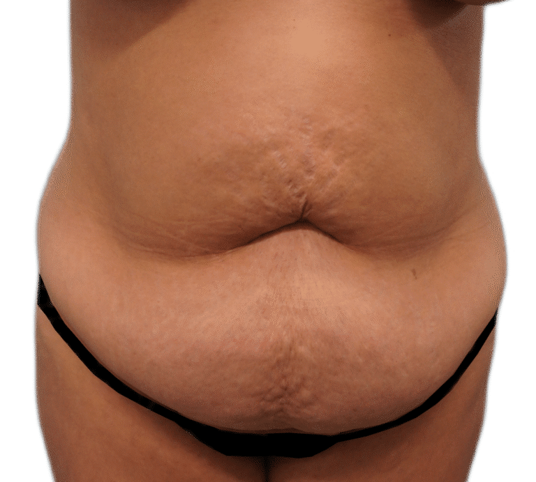Before Image: Tummy Tuck - front