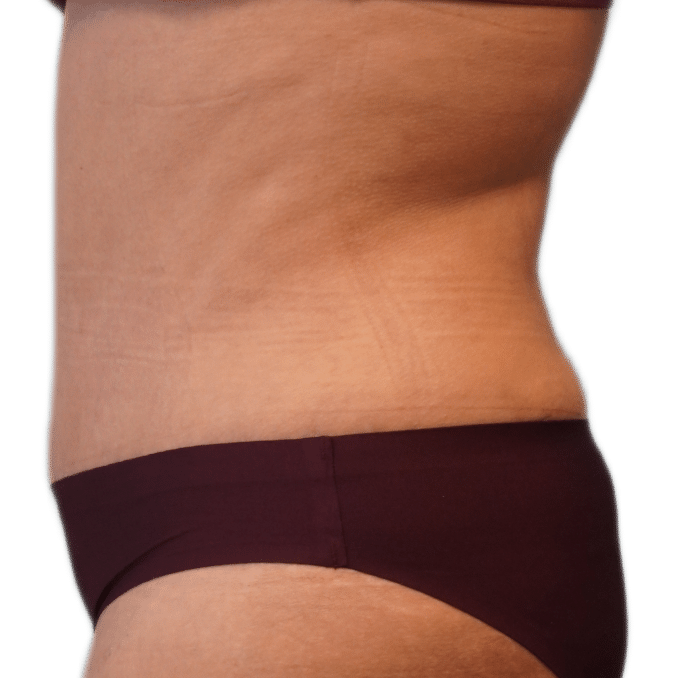 After Image: Tummy Tuck - left-side