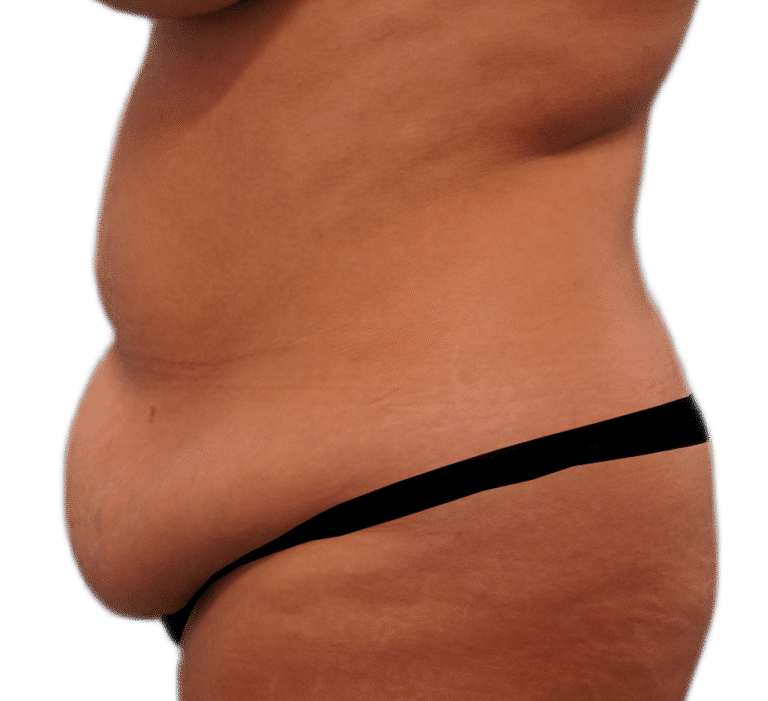 Before Image: Tummy Tuck - left-side