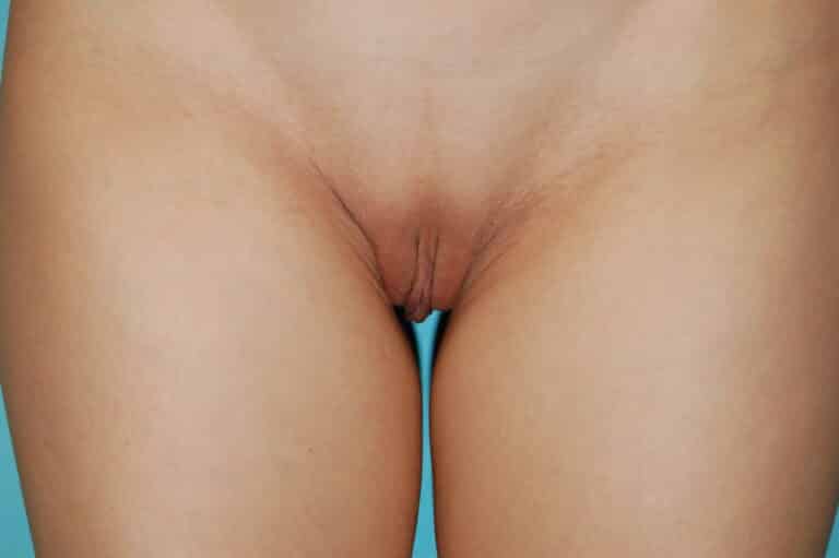 Before Image: Vaginoplasty - front