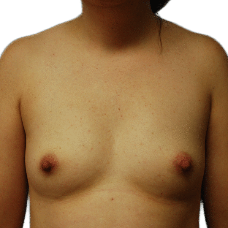 Before Image: Fat Grafting to Breast with Liposuction - front