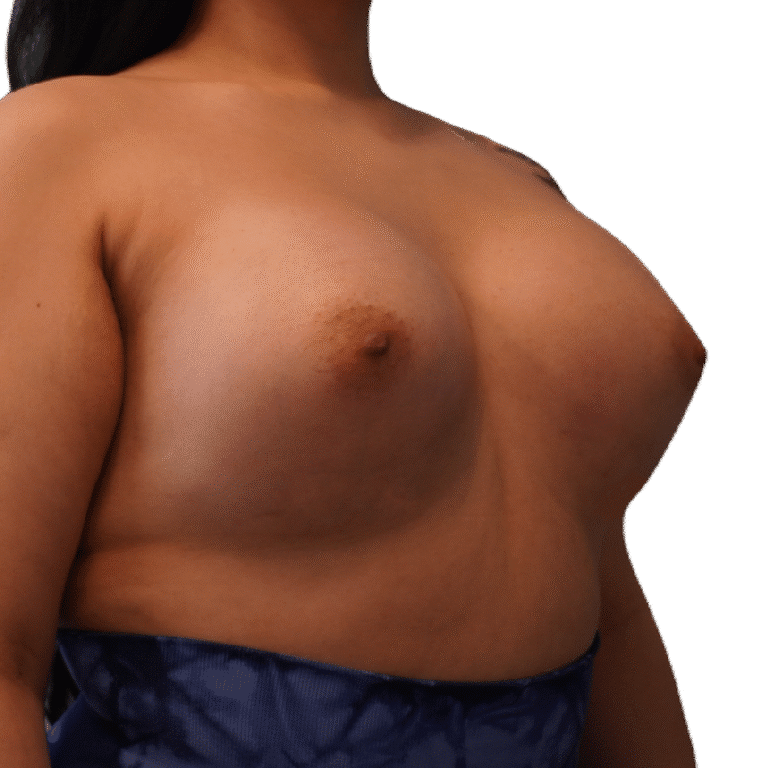 After Image: Breast Augmentation - left-front-oblique