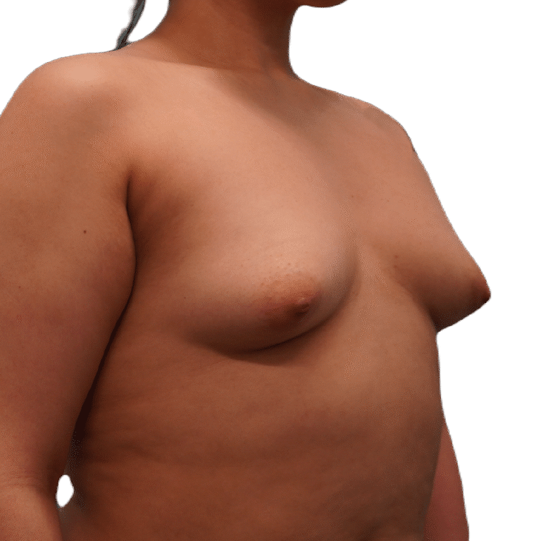 Before Image: Breast Augmentation - left-front-oblique