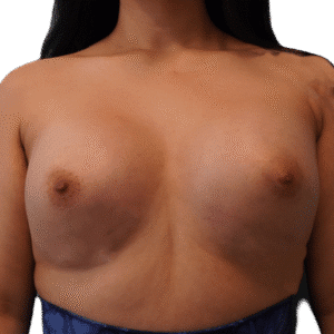 After Image: Breast Augmentation