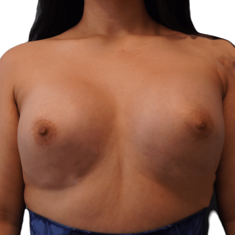 After Image: Breast Augmentation - front