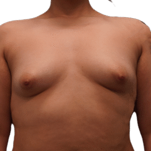 Before Image: Breast Augmentation