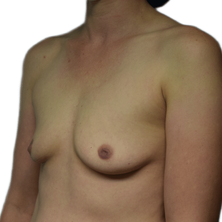 Before Image: Breast Augmentation - left-front-oblique
