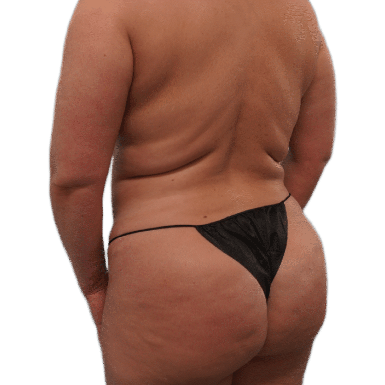 Before Image: Back Tuck - left-back-oblique