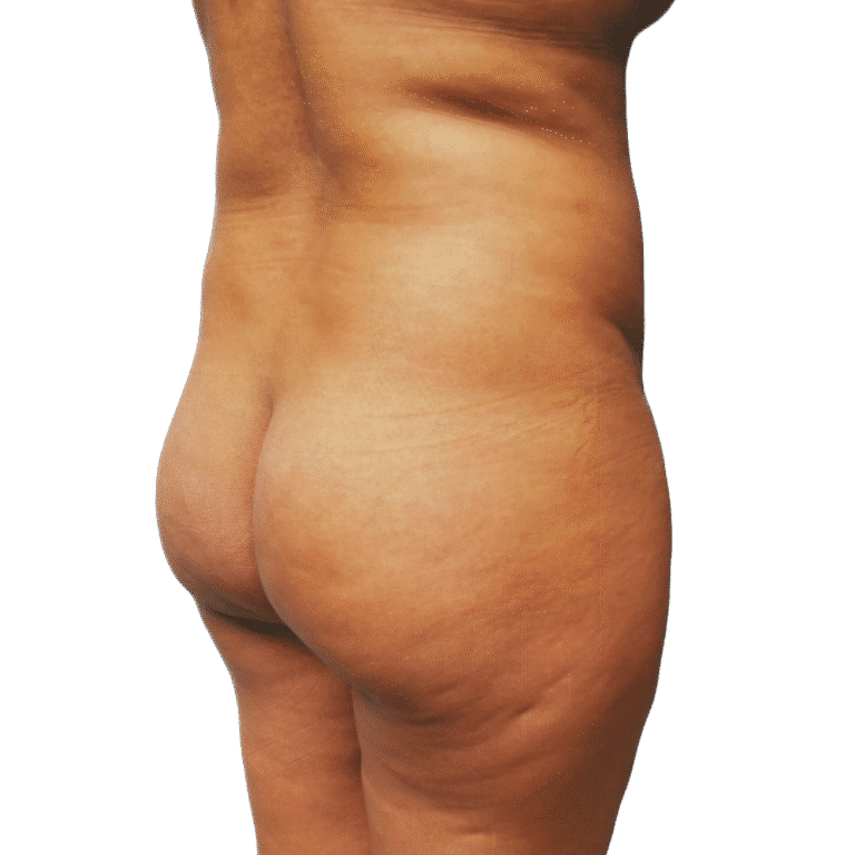 Before Image: BBL - right-back-oblique