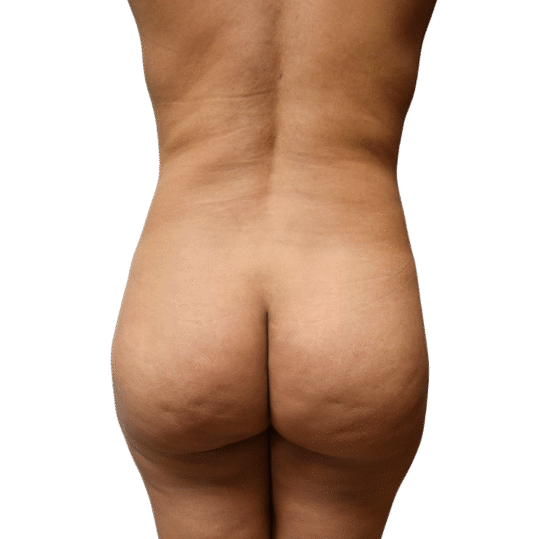 After Image: BBL - back