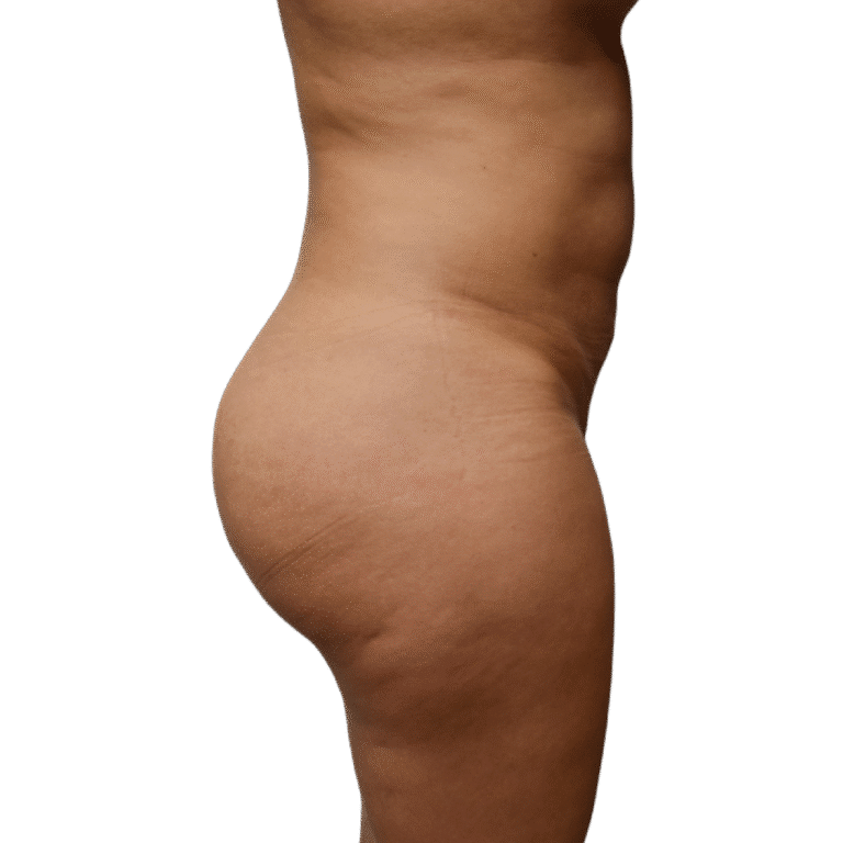 After Image: BBL - right-side