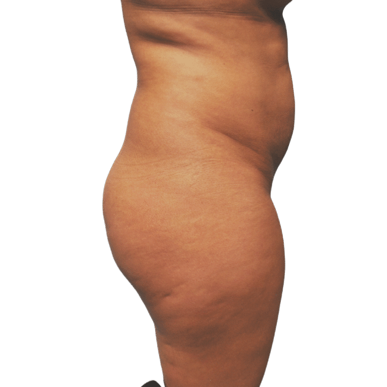 Before Image: BBL - right-side