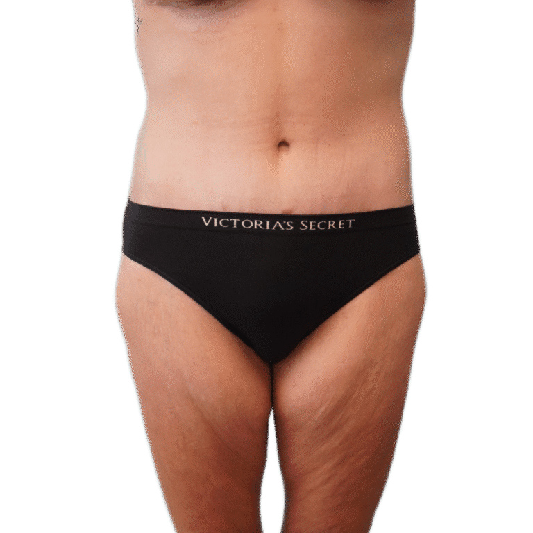 After Image: Body Lift - front