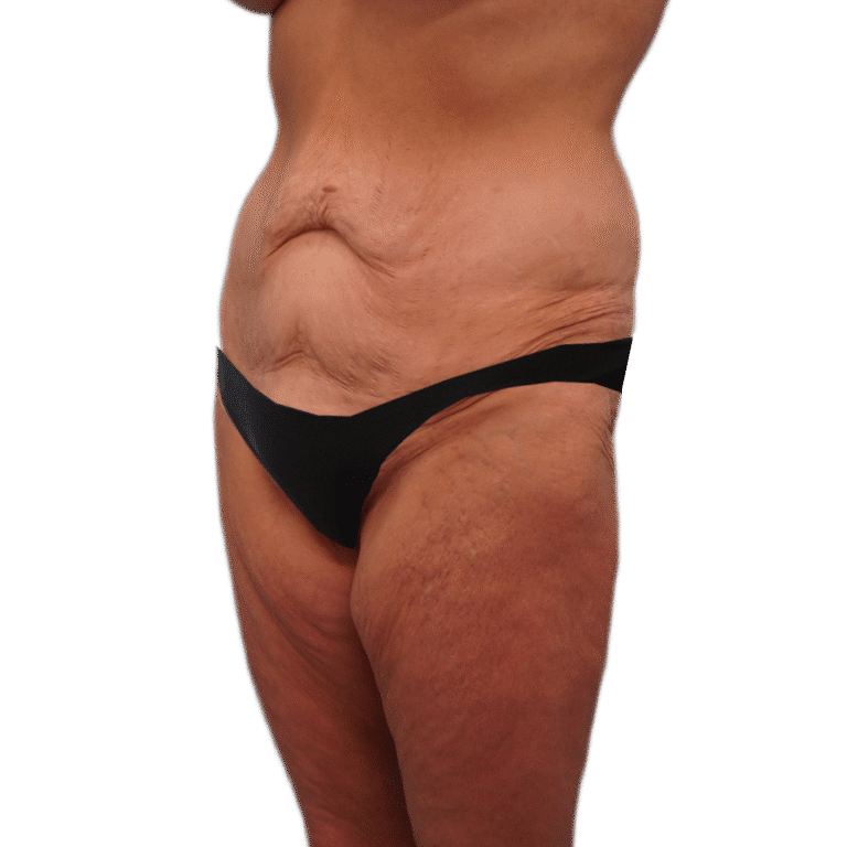 Before Image: Body Lift - left-front-oblique