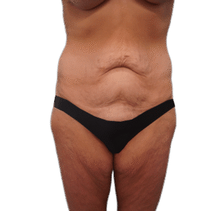 Before Image: Body Lift