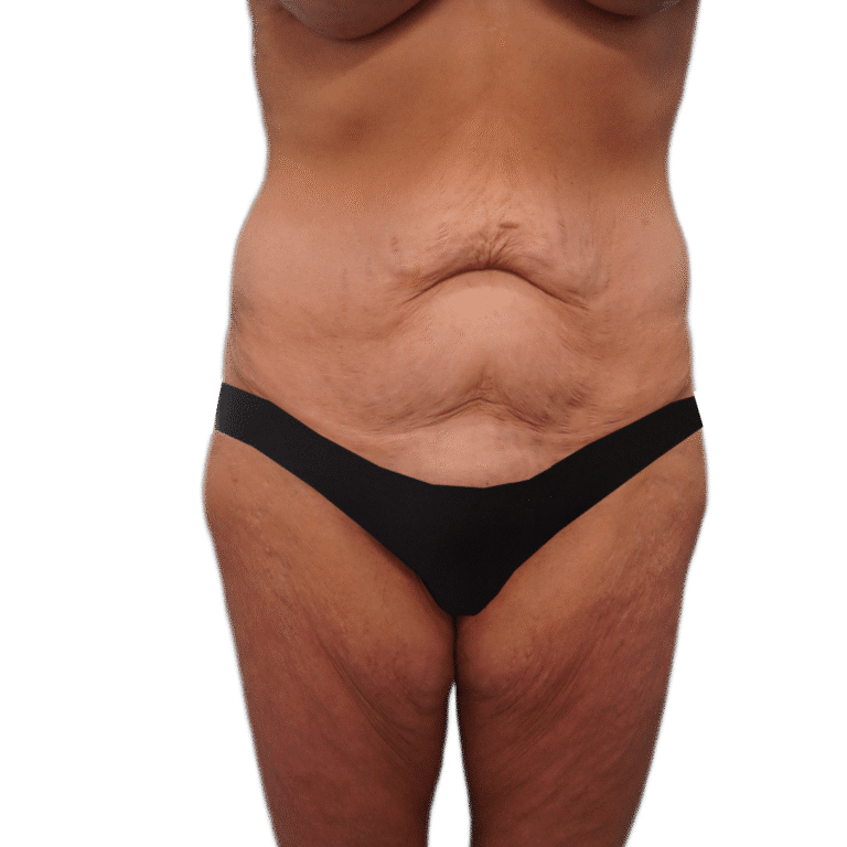 Before Image: Body Lift - front