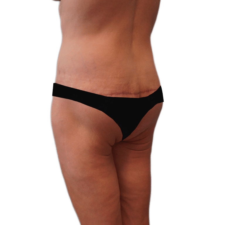 After Image: Body Lift - left-back-oblique