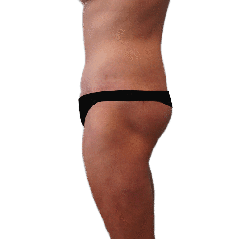 After Image: Body Lift - left-side