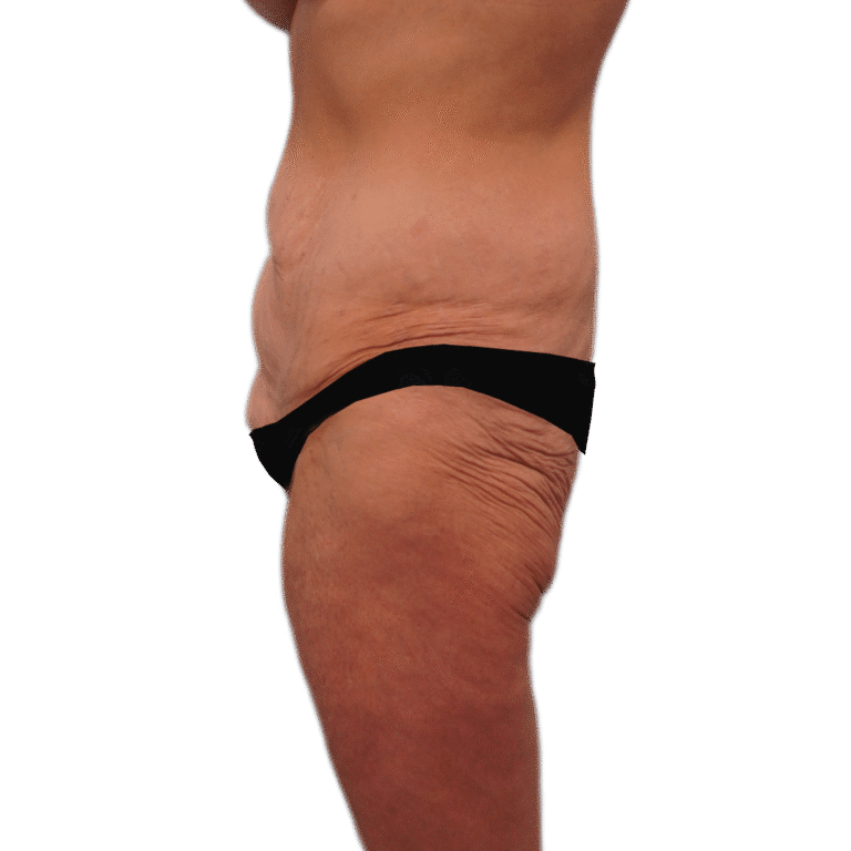 Before Image: Body Lift - left-side