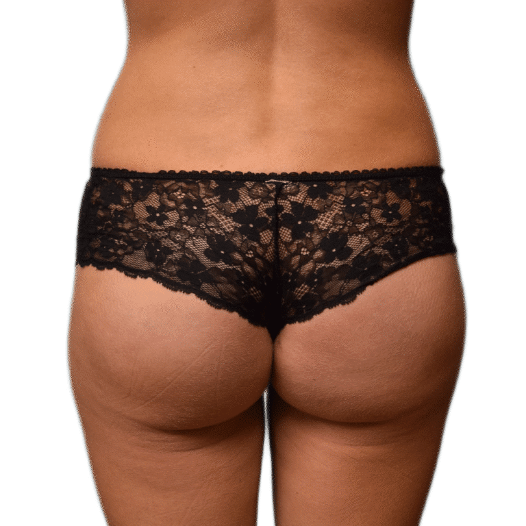 After Image: Butt Implants - back