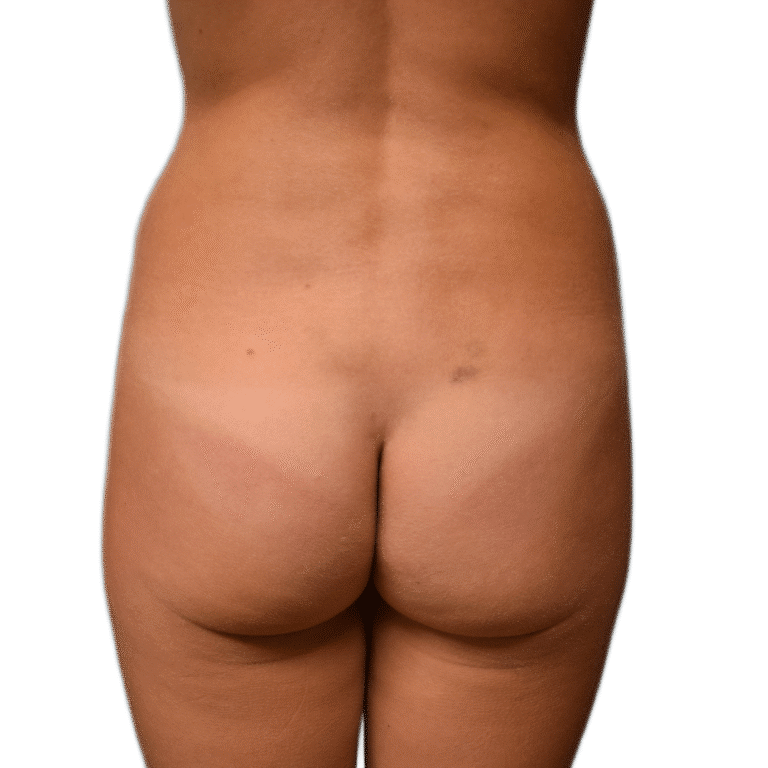 Before Image: Butt Implants - back
