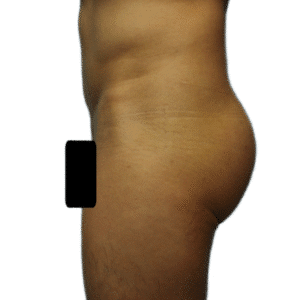 After Image: Butt Implants