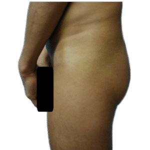 Before Image: Butt Implants