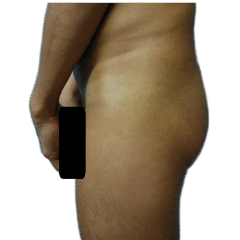 Before Image: Butt Implants - front