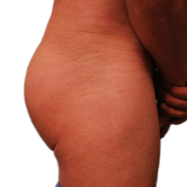 After Image: Butt Implants - right-side