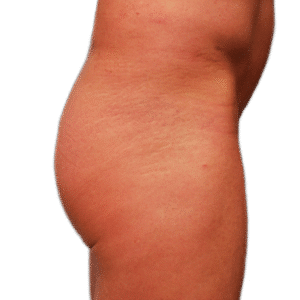 Before Image: Butt Implants