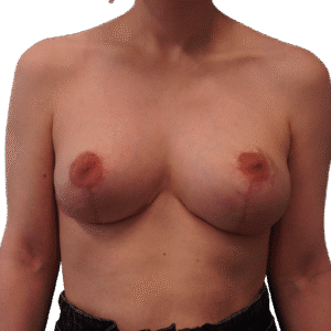 After Image: Breast Lift w/out Augmentation