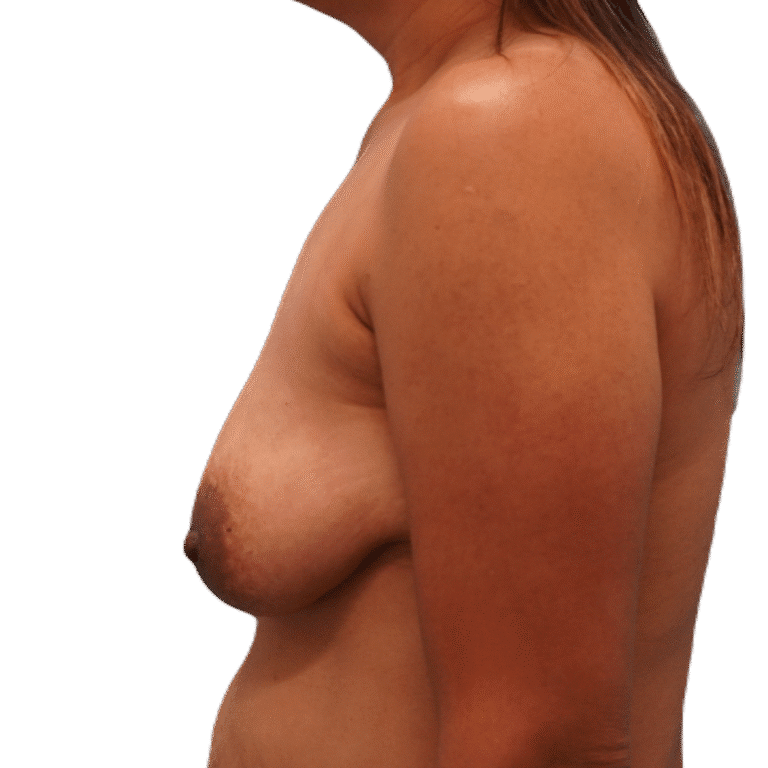 Before Image: Breast Augmentation & Lift - left-side