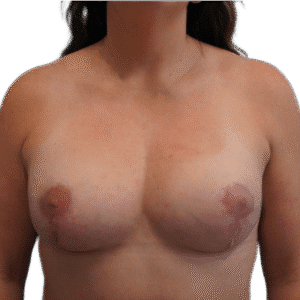After Image: Breast Augmentation & Lift