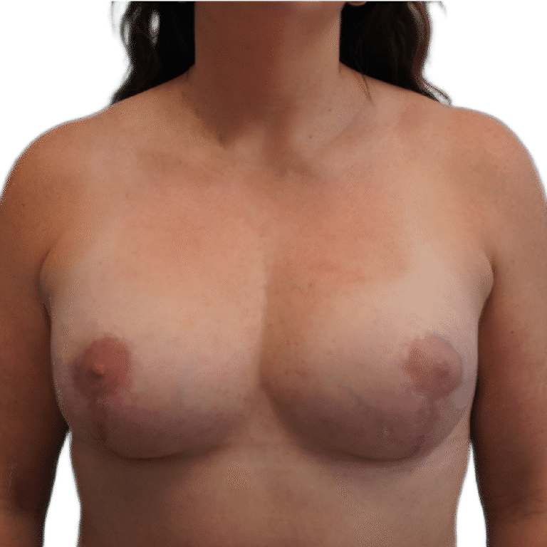 After Image: Breast Augmentation & Lift - front