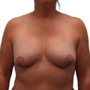 Before Image: Breast Augmentation & Lift