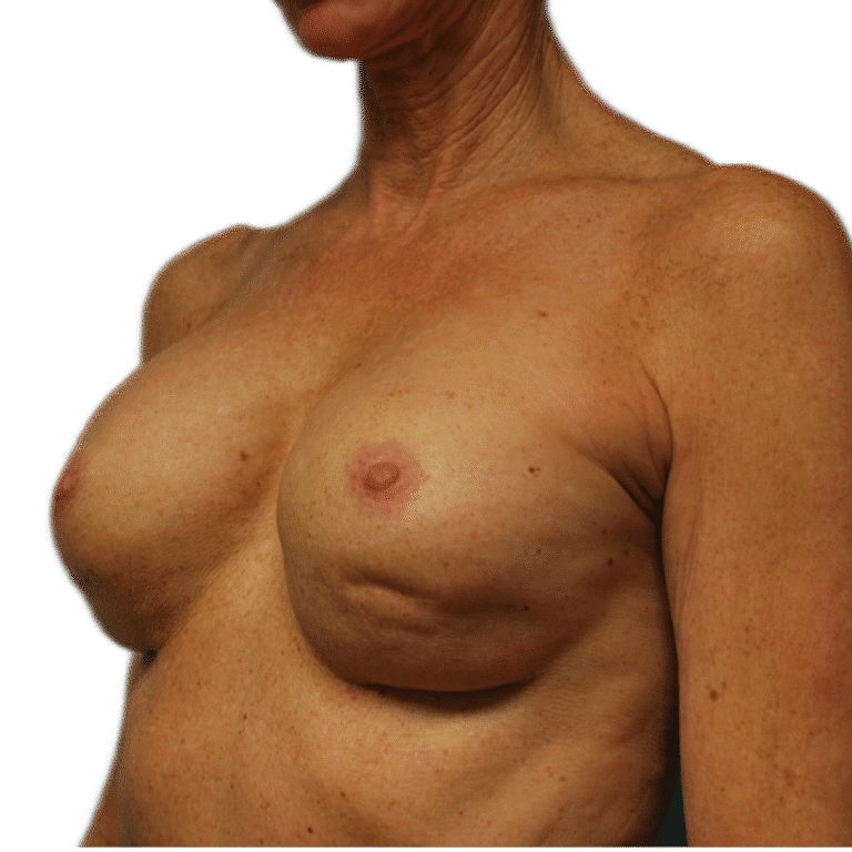Before Image: Revision Breast Augmentation - left-front-oblique