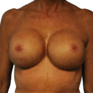 After Image: Revision Breast Augmentation