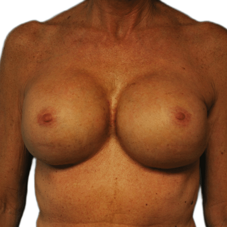 After Image: Revision Breast Augmentation - front