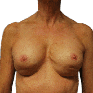 Before Image: Revision Breast Augmentation
