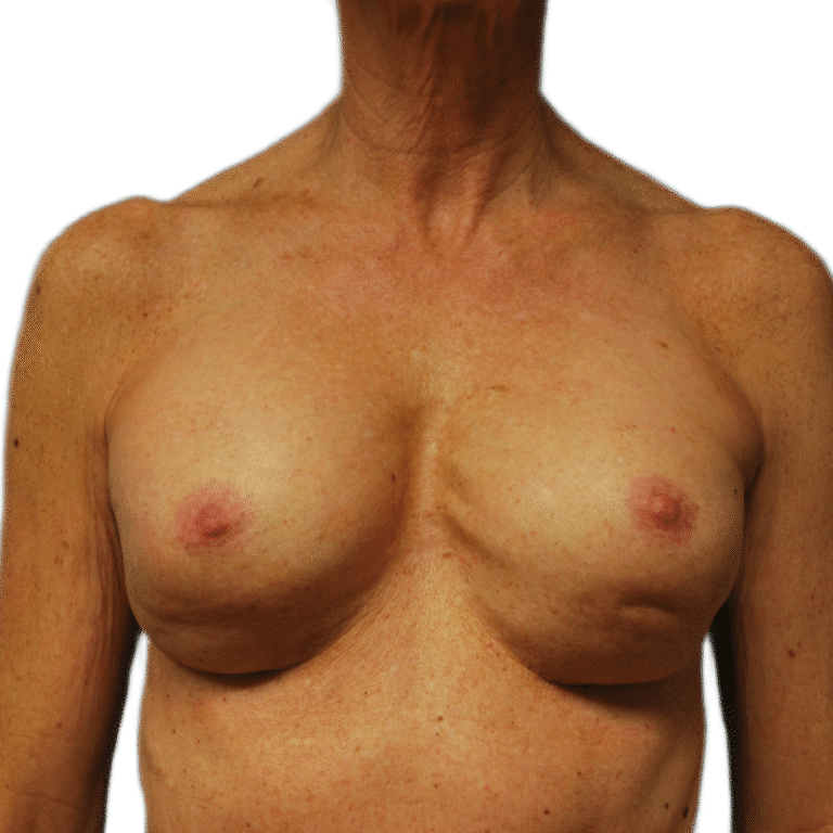 Before Image: Revision Breast Augmentation - front