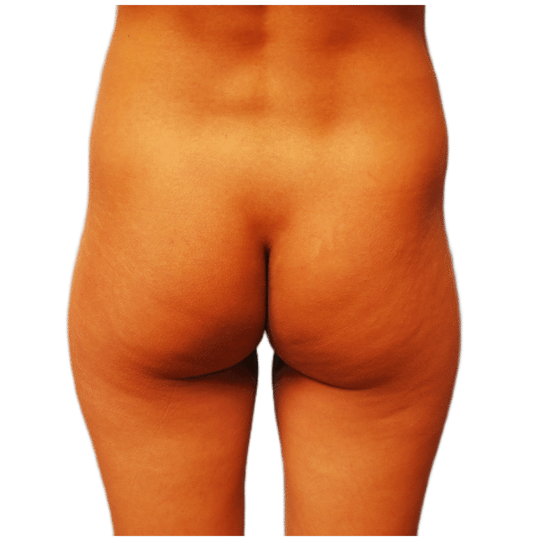 Before Image: BBL - back