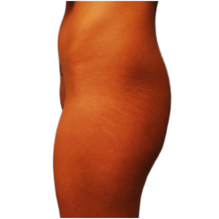 Before Image: BBL - front