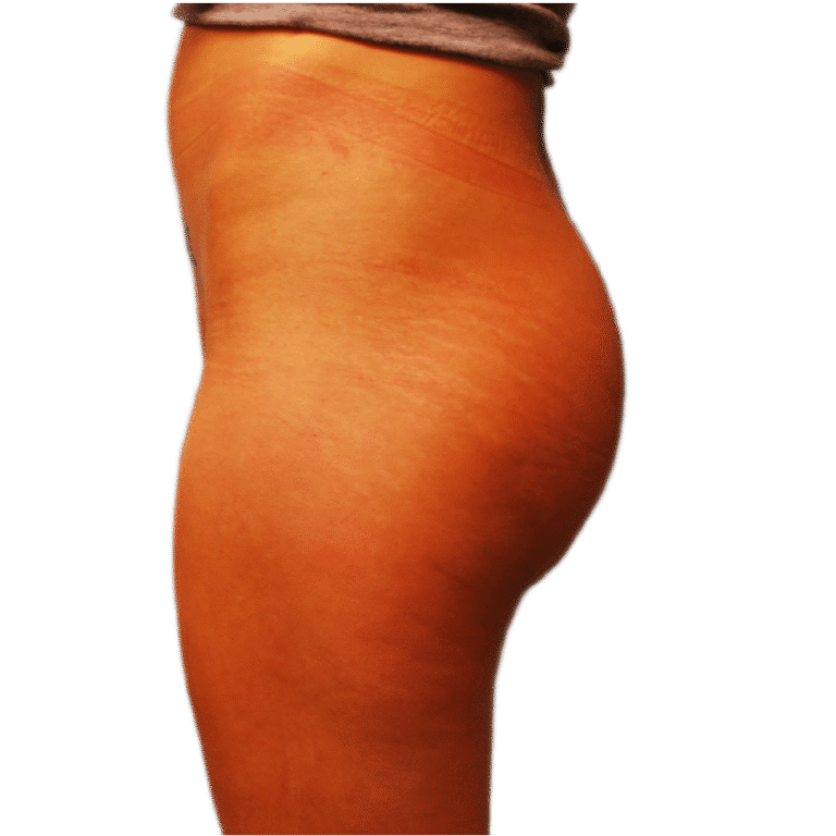 After Image: BBL - front