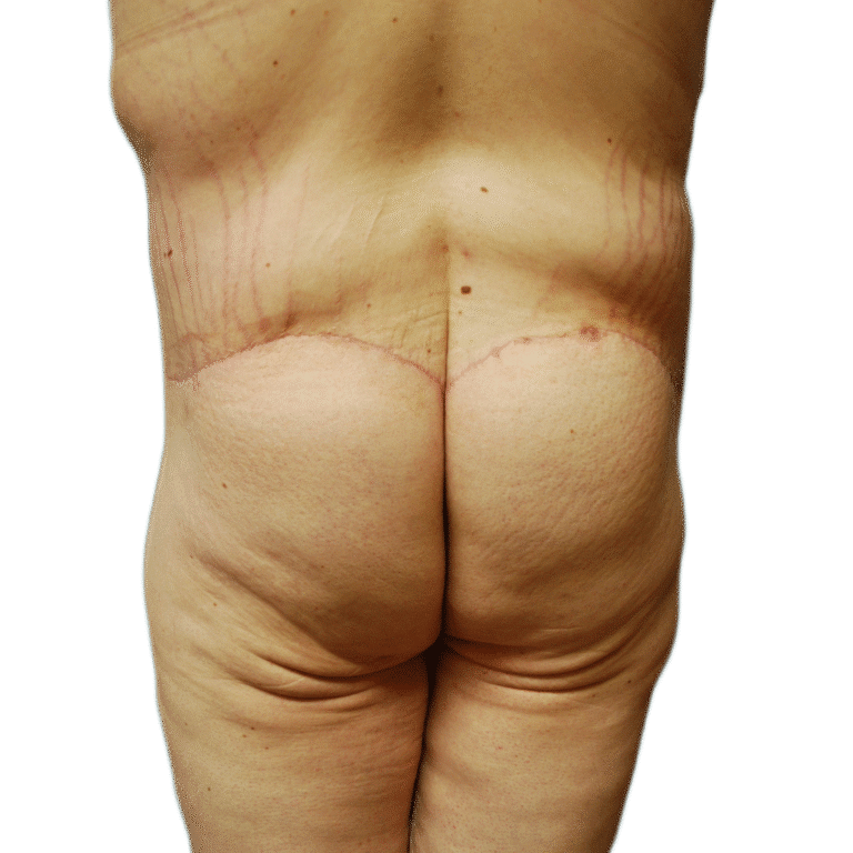 After Image: Butt Lift - front