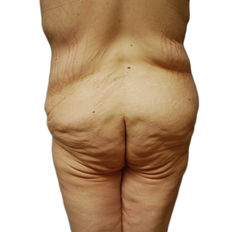 Before Image: Butt Lift - front