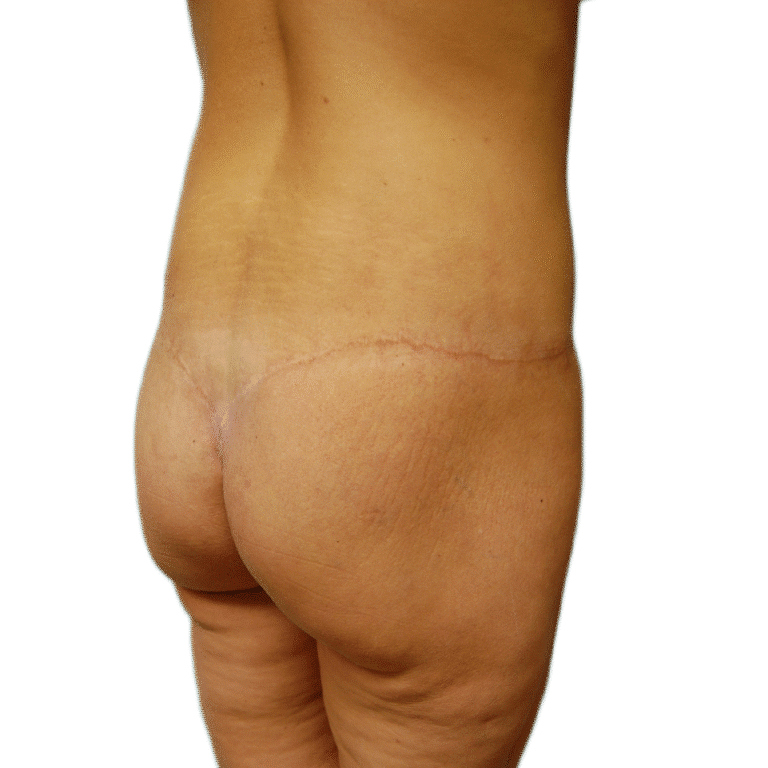 After Image: Butt Lift -