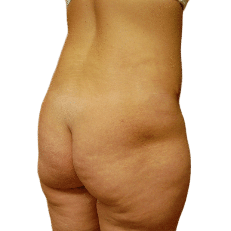 Before Image: Butt Lift -