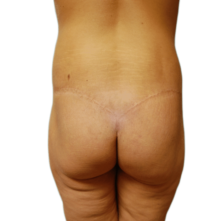 After Image: Butt Lift - back